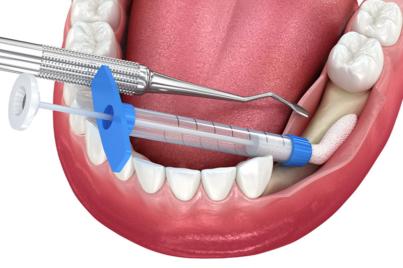 Bone Grafting in Phoenix