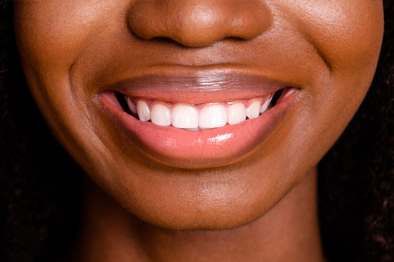 Gummy Smile Reduction in Phoenix