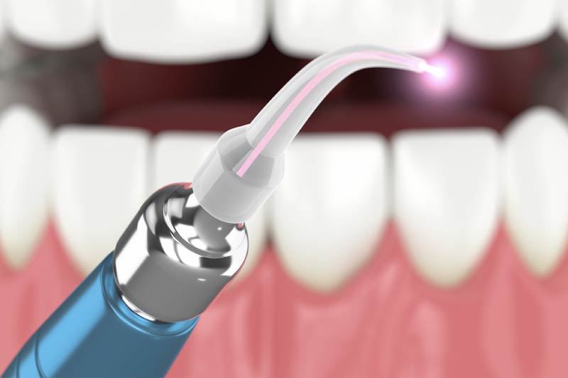 Laser Dentistry in Phoenix