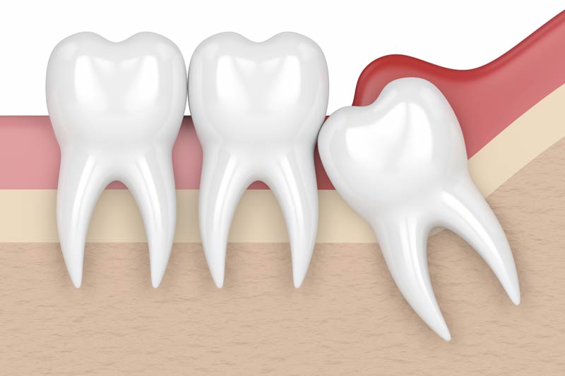 Wisdom Tooth Removal in Phoenix