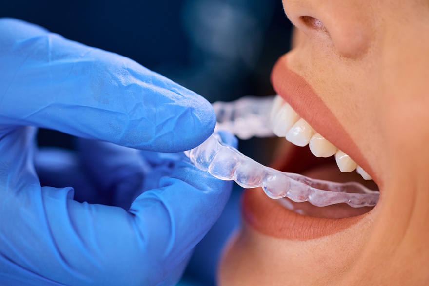 invisible clear aligners on woman's teeth