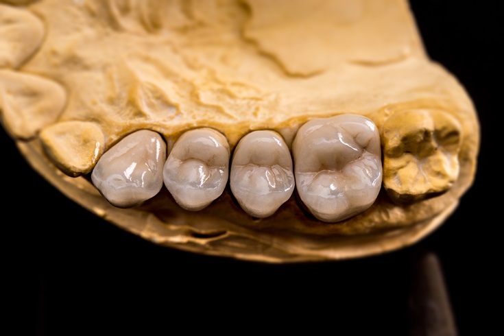 Lost Dental Filling or Crown