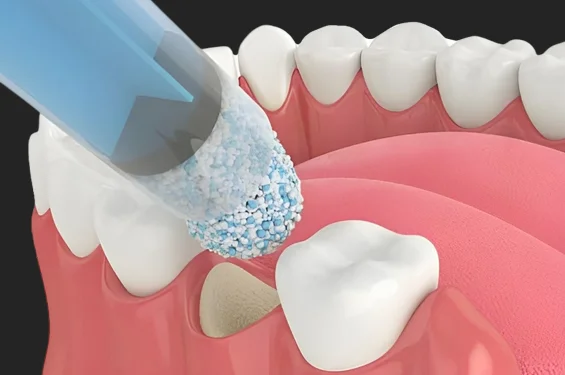 bone grafting phoenix