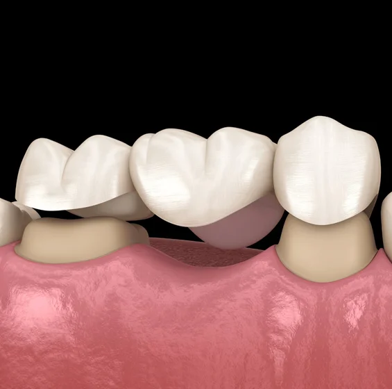 dental bridges in phoenix