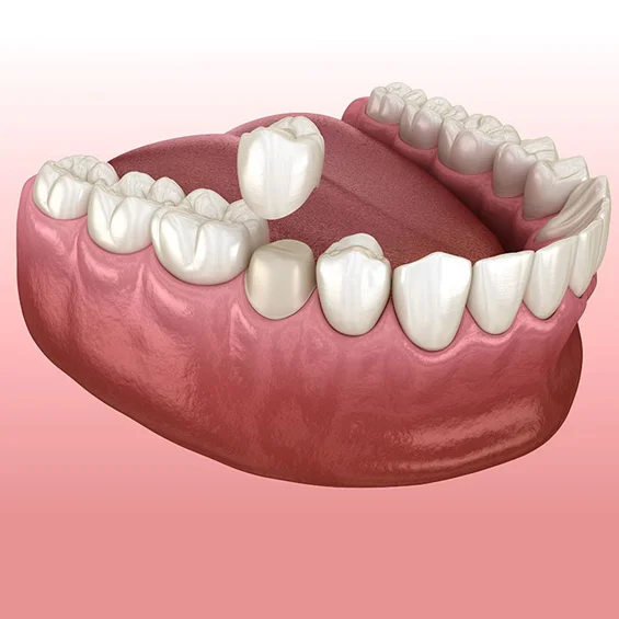 dental crowns in phoenix