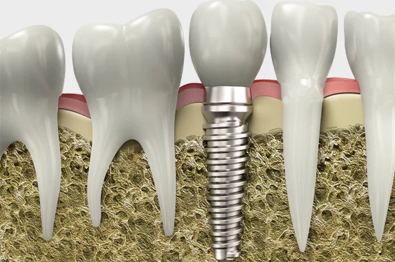 dental implants phoenix