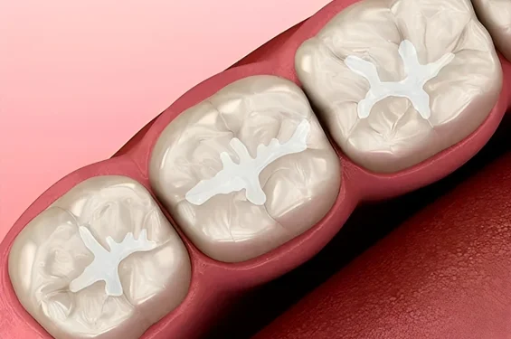 filling sealants on teeth in phoenix