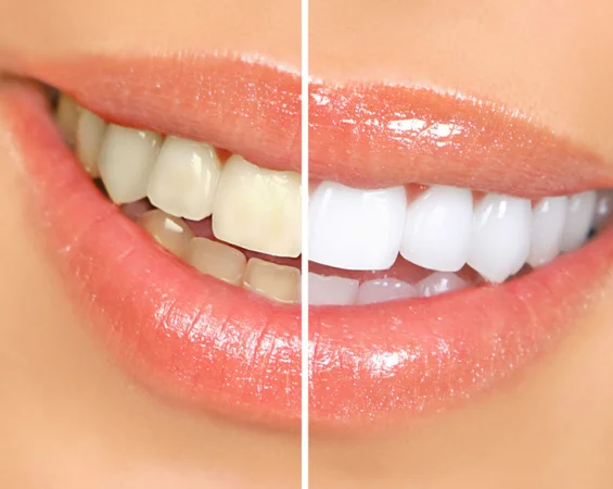 Bright smile after teeth whitening treatment phoenix
