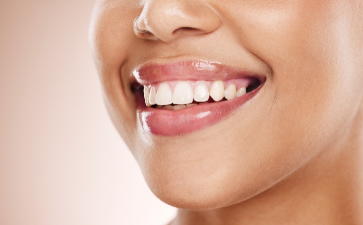 Close-up of a woman’s smile showing healthy, glossy lips and white, well-aligned teeth with cosmetic dental treatment.
