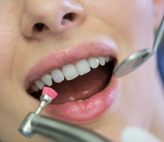 A close-up image of a young woman's mouth is undergoing a dental cleaning treatment with a dental tool and a mirror held by a dentist